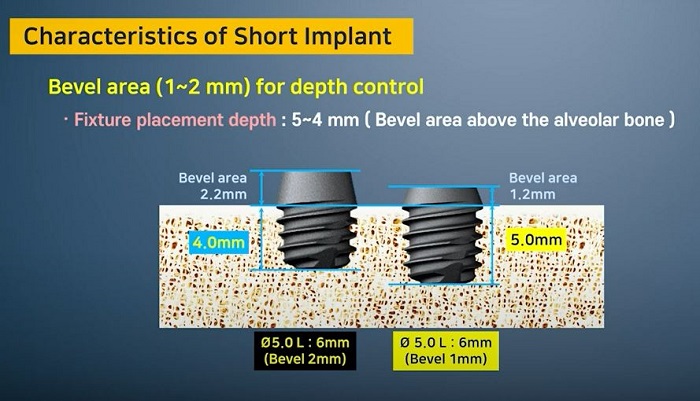 Short implant.JPG